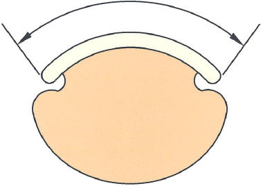 Nail surface width Nail corrected with Robo