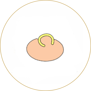 severe ingrown nail