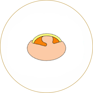 A severe ingrown nail can be corrected to its beautiful shape.