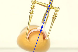 If the pain is too strong to tighten until the space between the pressurizer and the plunger is gone...